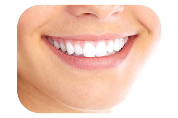 オフィスホワイトニング